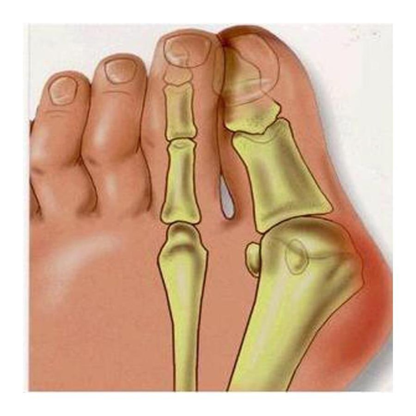 Protetor de Pé Dogma Hallux Valgus  para Joanete em Silicone - Par - Foto 3